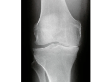 Diagnóstico de artrosis de la articulación de la rodilla
