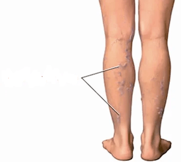 Las consecuencias de la rodilla ilegal