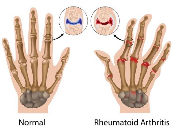 Articulaciones dita sin patología y con artritis reumatoide