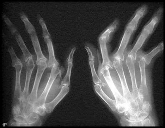 Manos de racción cuádruple afectadas por la osteoartritis