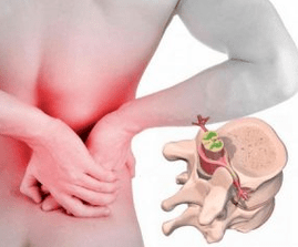 Lumbago al comienzo de la enfermedad osteocondosa