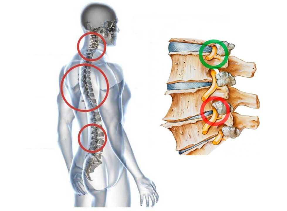 Cómo aparece la osteocondosis cervical de las vértebras