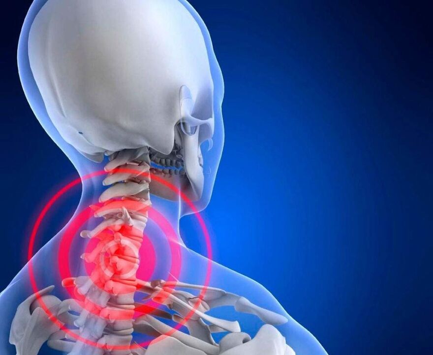 Dolor de cuello con osteocondosis cervical
