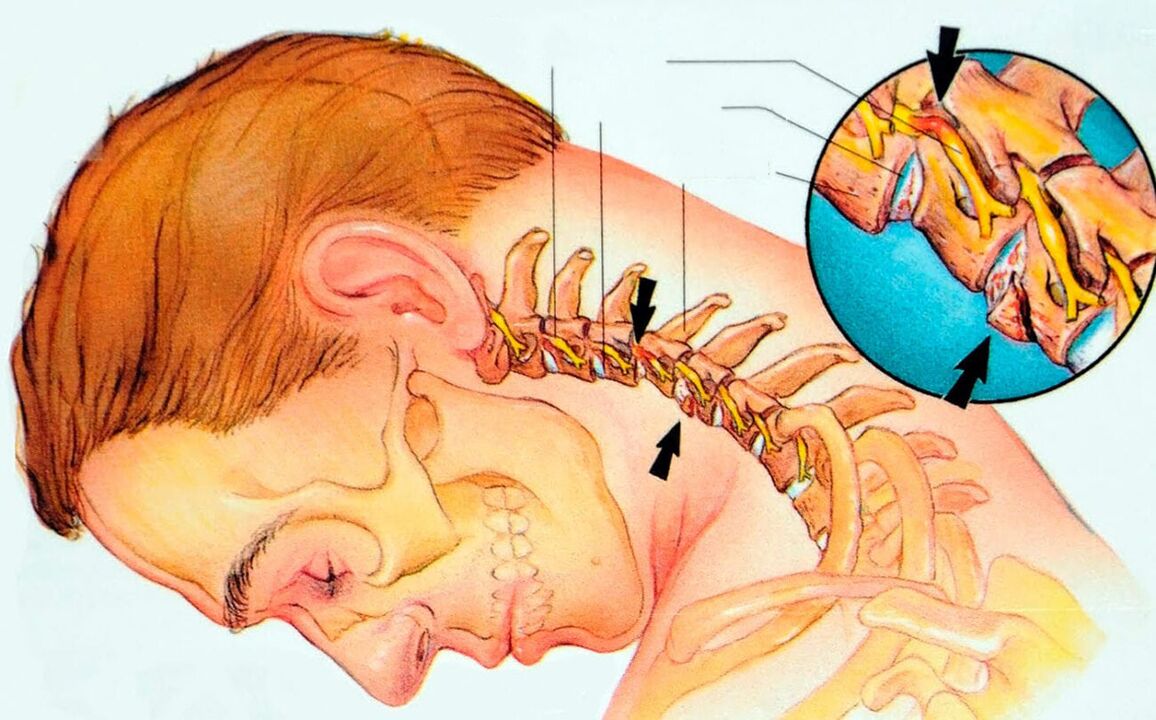 ¿Qué es la osteocondosis cervical
