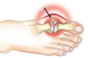 Daño articular debido a artritis y osteoartritis.