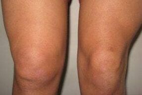 Inflamación de la articulación de la rodilla con artritis y artrosis.