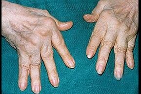 síntomas de artritis en los dedos