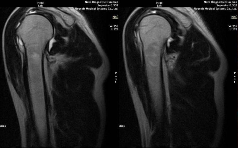 artrosis de la articulación del hombro en radiografía