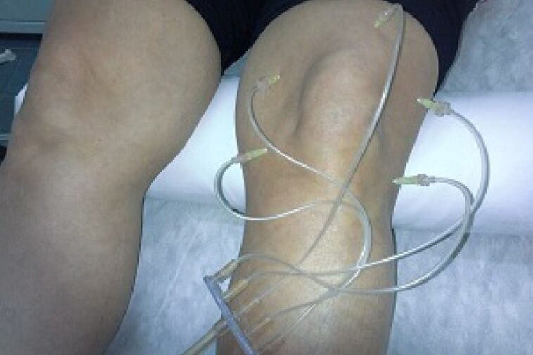 Ozonoterapia