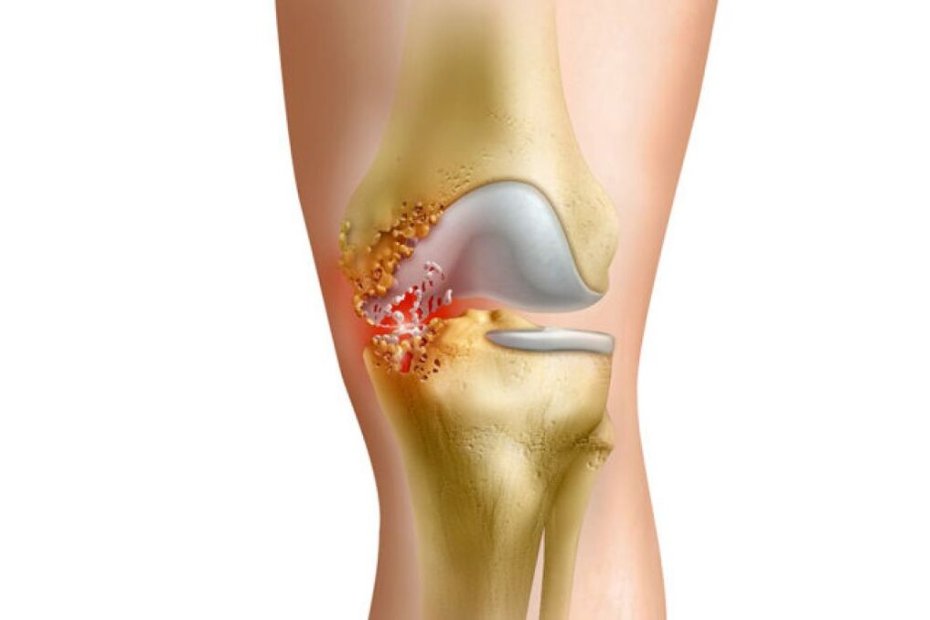 inflamación como causa de dolor en la articulación de la cadera
