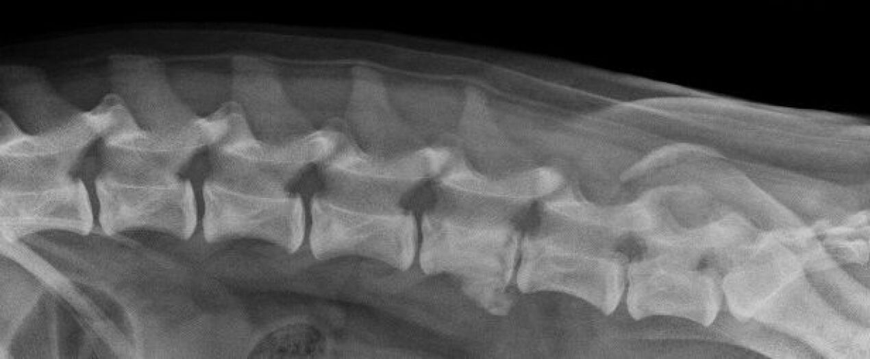 Manifestaciones de osteocondrosis de la columna torácica en una radiografía. 