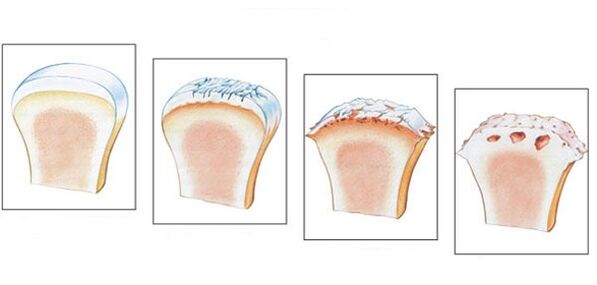 Articulación del tobillo sana y grado de desarrollo de artrosis. 