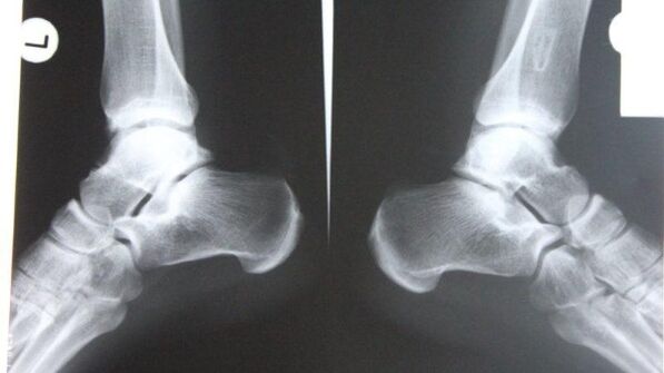 Diagnóstico de artritis de tobillo mediante radiografía. 